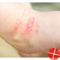 Eczema in babies and children